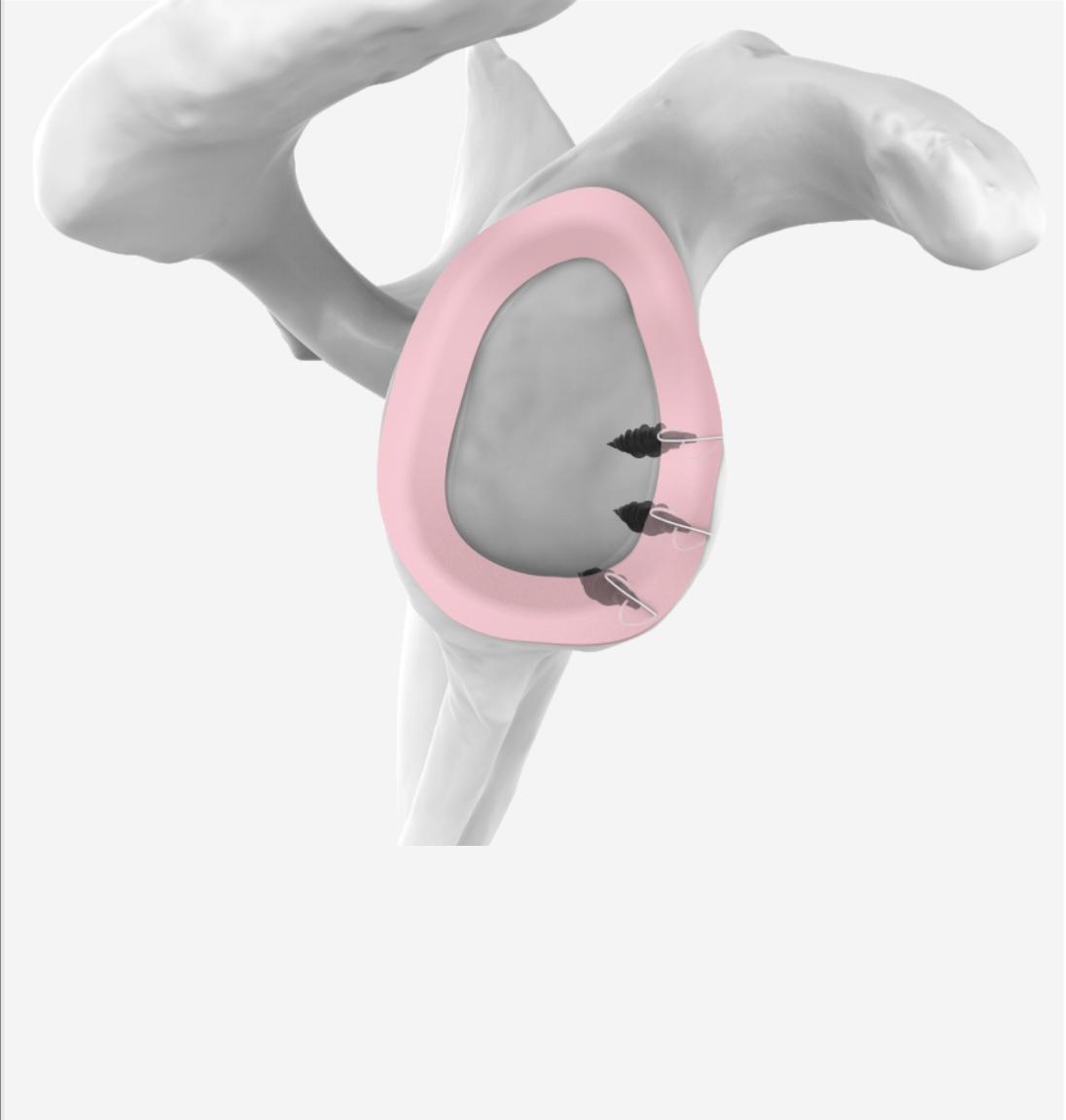 Sport Surgeries